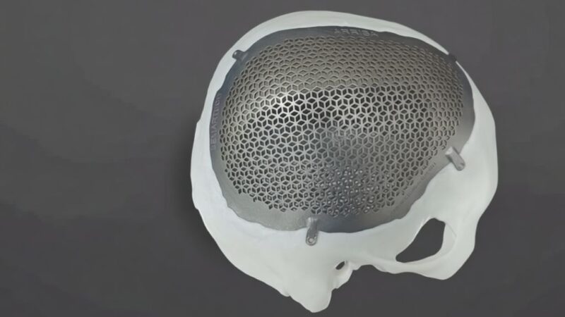 BEMART desarrolla implantes médicos 3D hechos a medida