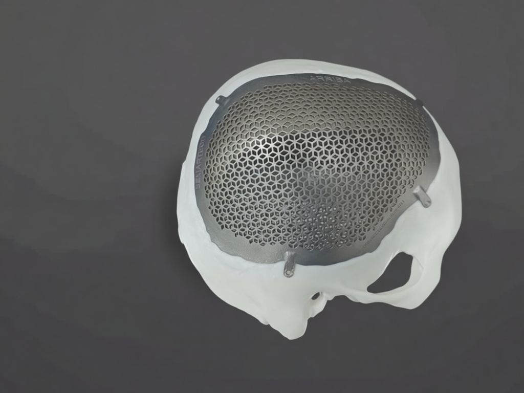 BEMART desarrolla implantes médicos 3D hechos a medida